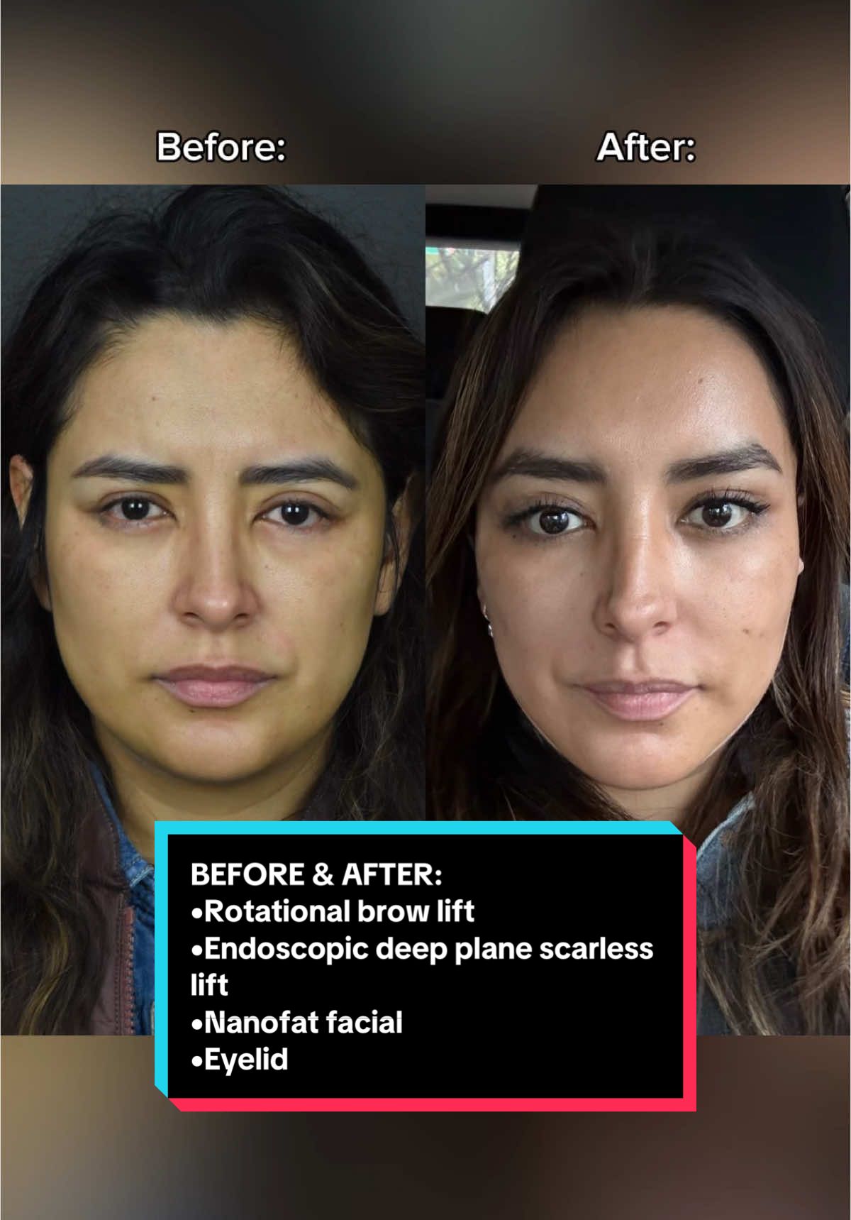 Before & after check! ✨  My patient was unhappy with her prior eyelid surgery done elsewhere. She underwent a rotational brow lift, endoscopic deep plane scarless lift, and nano fat facial. What do you guys think? 🙌🏻☺️ #beforeandafter #plasticsurgery #browlift #deepplanefacelift 