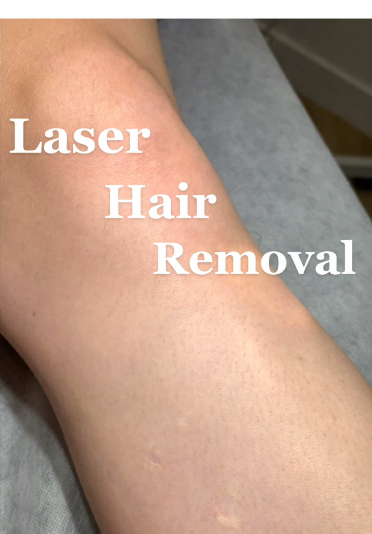 Are you tired of ingrown hairs, shaving, razor burns & strawberry legs ?? Start Laser hair Removal to get Silky Smooth Hair-free Legs. Contact Desire Laser at 780-225-6364 for free consultation or book an appointment online through our website: www.desirelaser.com  #laserhairremoval #bestlaserhairremoval #edmontonlaserhairremoval #desirelaser #bestlaserclinicinedmonton #laserhairremovaledmonton #effectivelaserhairremoval #permanenthairremoval #effectivelaser #diodelaser #ipl #photofacial #skinrejuvenation #skincare #skintreatment #edmontonmedispa #edmonton #yeg #lasertreatment #beauty #edmontonbeauty #yegbeauty #laserresults #yegdeals #edmontoncommunity #foryou #foryoupage #trend #viral 