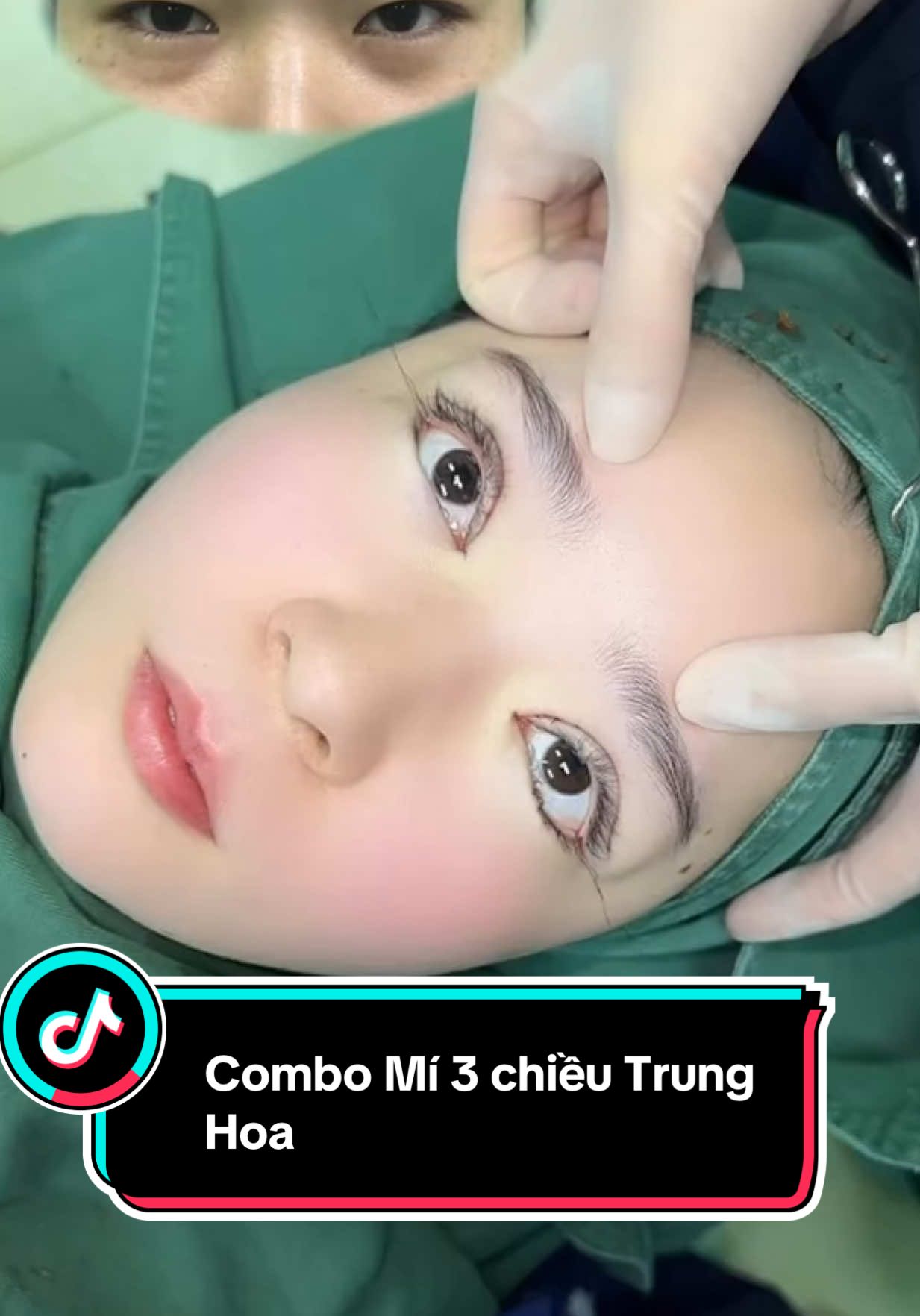 Combo giúp đôi mắt to tròn form mắt ShangHai #catmi #mogocmat #rhinoplasty #malaysia #bsdung 