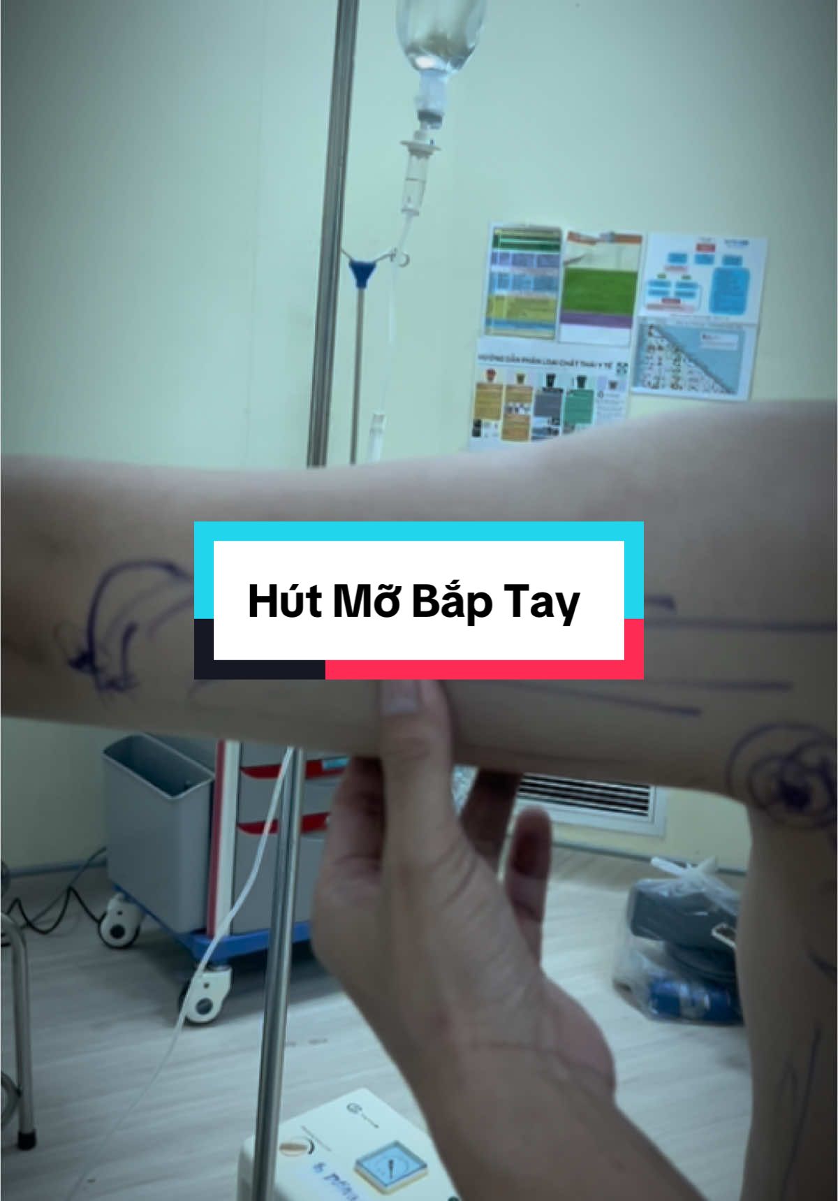 Hút Mỡ Bắp Tay  #nangngucdanang #hutmobaptay #hutmo #bacsihoquangco 