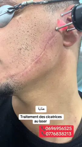 #drchaallel #cliniceldhia #عيادة_الضياء #دكتورشعلال #annaba #algerie #oran #skikda #batna #taref #guelma #soukahras #الجزاير🇩🇿 #الجزائر🇩🇿 #عنابة #laser #poredilaté #مسامات_البشرة #cicatrices #cicatricesacne #cicatrice #ندبات #ندبات_حب_الشباب #ندبات_جراحية #ندبات_وثقوب_الوجه #cicatrices #blessure #blessures #visage 