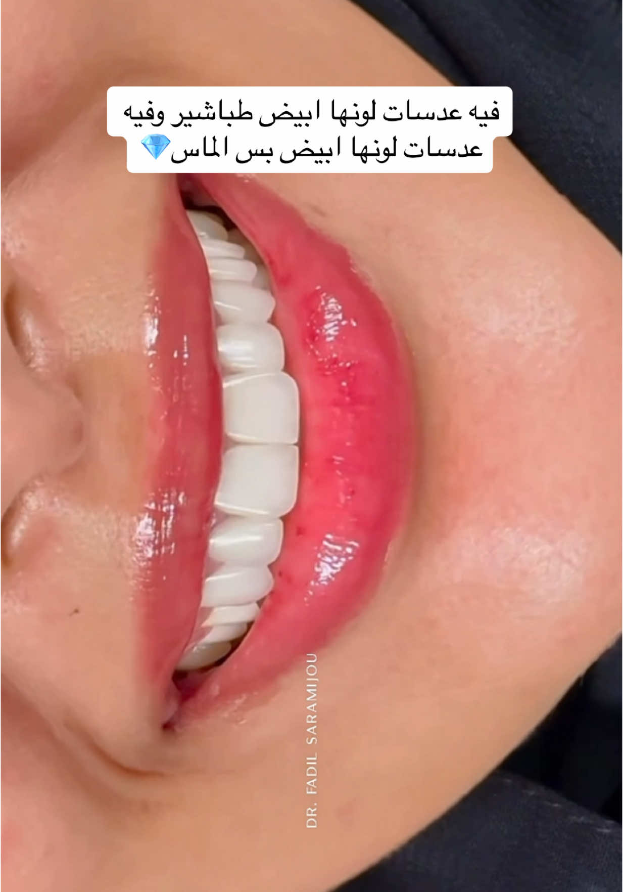 غيرنا العدسات والتركيبات القديمه وجملنا اللثه وعالجنا الاعصاب ودعمنا باوتاد وبس والله#الرياض_الان #tik_tok #السعودية #اكسبلورexplore #كافيهات #كافيهات_الرياض #ابتسامة #تجميل_الاسنان #رمضان #مترو 