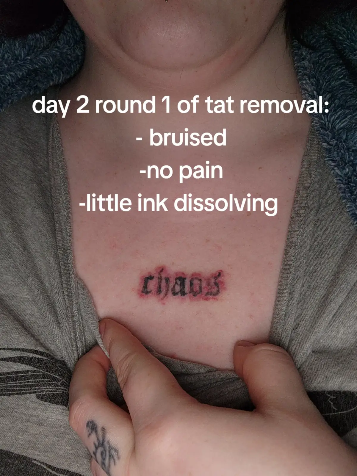 #tattooremoval 