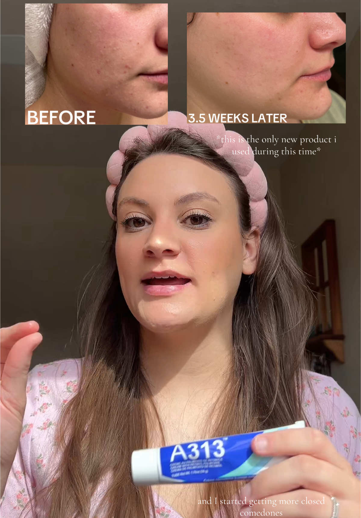 So happy I found this product!!! #frenchpharmacy #a313 #skincare #tiktokshop #tts #tiktokshopaffiliate #bestskincare #realreview #a313review #beforeandafter #closedcomodomes #closedcomedones #acneproneskin #sensitiveskin