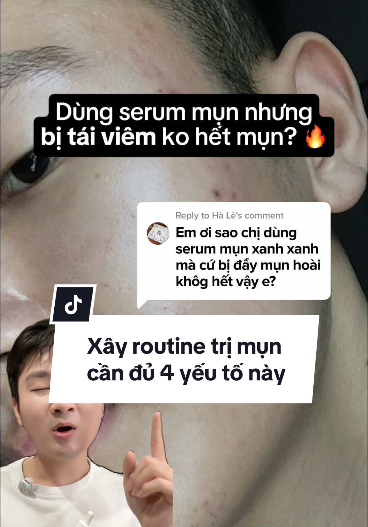 Vì sao dùng serum mụn mà da bị bùng viêm lên mụn nhiều hơn? Cách phối hợp hoạt chất để điều trị mụn trứng cá!  #damun #dadau #trimun #acnetreatment #acneroutine #routinetrimun #munviem #munan #serummun #BeautyTok #goclamdep #garniervn #skincare #serumkiemsoatmun #withbimm 