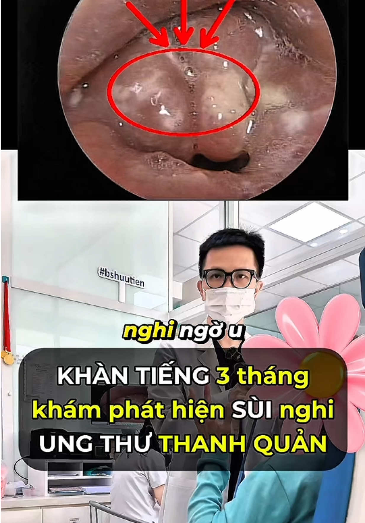 Khàn tiếng 3 tháng đi khám phát hiện khối sùi thanh quản nghi U #khantieng #ungthuthanhquan #laryngealcancer #bshuutien #taimuihong #nhidong  #phongkhamtenlua #goldmedclinic #noisoitaimuihong #phongkhamgoldmed #bacsigoldmed #anhemnhabacsi 