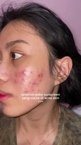 pokoknya harus pake sunscreen yang aman buat acne, kalo ga mau breakout lagi🥹🫵🏻 @Acnaway Official  #sunscreen #acneskin #breakout #sunscreenreview #Acnaway #SafeorAcneSkin 