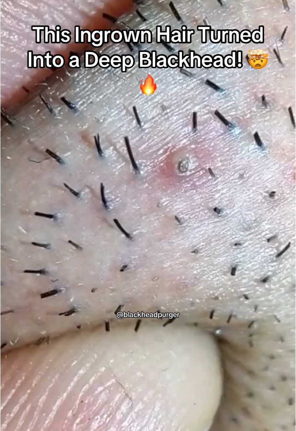 😱 What started as a simple ingrown hair became a HUGE blackhead! 🛠 Carefully extracting it without damaging the skin. 🤯 The end result is SO satisfying—you have to see it! 💬 Have you ever had one like this? Let me know in the comments! 👇 📲 Follow for more crazy extractions! 🚀 #blackhead #blackheadextraction #ingrownhair #pimplepopping #whitehead #satisfyingvideos #oddlysatisfying #viral #skincare #dermatology #beardcare #porecleaning #fyp 