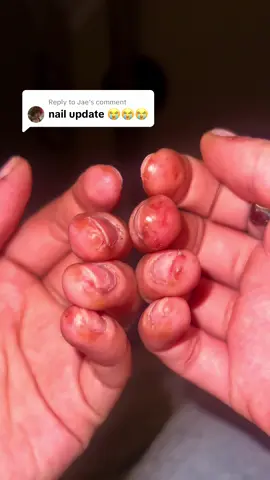 Replying to @Jae #gelxallergy #gelxnails #gelxtips #fyp #contactdermatitis #gelnails #gelnail #chemicalburn 