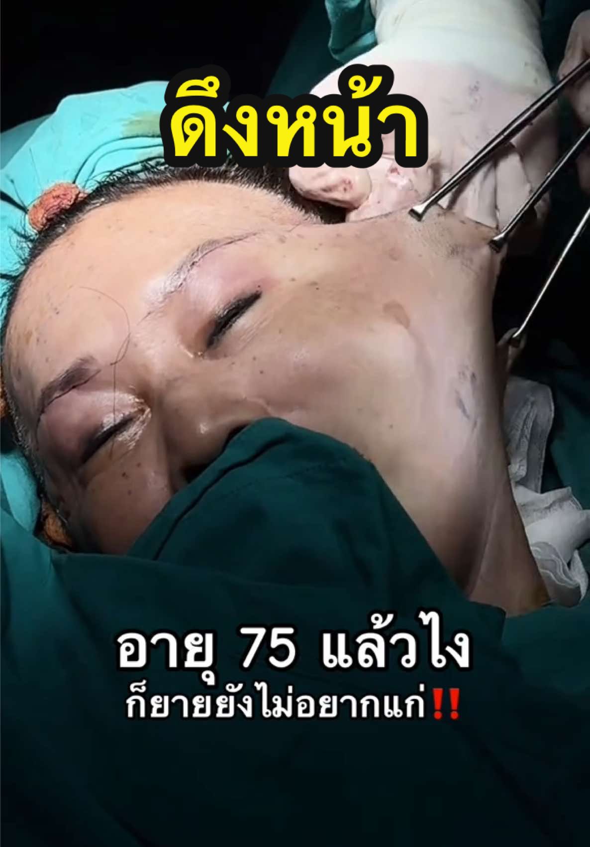 เหี่ยวตรงไหน ดึงตรงนั้น‼️ #ดึงหน้า #facelift #подтяжкалица #ลดอายุ #ดึงหน้าลดอายุ #ป้าวัย70ยังสวย #คุณยาย #อายุ70 #หน้าเหี่ยว #หน้าแก่ #ยกคิ้ว #ตาสองชั้น #หน้าเด็ก #ย้อนวัย #รีวิวดึงหน้า #รีวิวศัลยกรรม #ศัลยกรรม #เลอนิสต้าคลินิก #lenistaclinic 