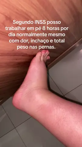 #linfedema #linfedemaprimario #edema #angiologia #pernasinchadas #erisipela 