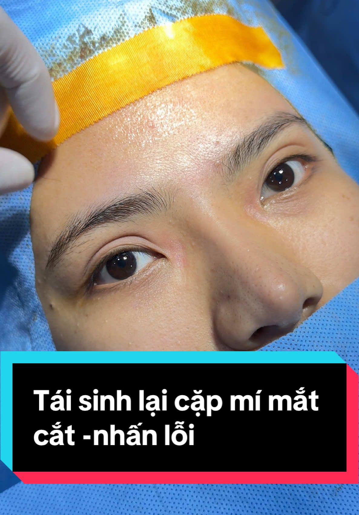 Combo mí sửa full deep + mở góc trong #nose #eyelid #trending #viral #trendingvideo #tiểu_phẫu #cắt_mí_đẹp_sài_gòn #pttm #cắt_mí_tự_nhiên #plastic_surgery #cắt_mí_đẹp_HN_SG #cắt_mí_đẹp 