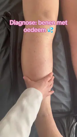 Diagnose: benen met oedeem 💦  #diagnose #lymfoedeem #lipoedeem #anticellulite #summerbody #vocht #waterretention #deeptissue #massage #cellulite #liposuction #bodyfix #amsterdam 