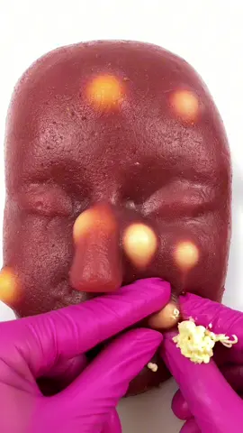 Now it’s time to squeeze those pimples. satisfying pimple popping #capcut #asmrtiktoks #acnetreatment #asmr #viralvideo #fypシ #pimple #pimplepopping #pimple_popper_asmr #tingles #asmrtingles #asmrtriggers #asmrsounds #mouthsounds #mochipimplepopping #bonniepimplepopperasmr 