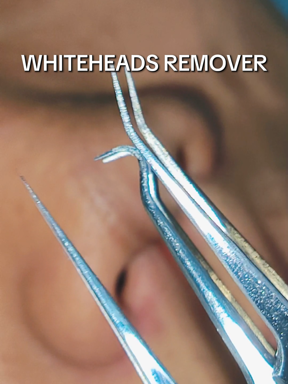 #whiteheads #whiteheadsremoval #blackheads #blackheadsremoval #satisfying #fyppppppppppppppppppppppp #fypシ゚ #fyp 