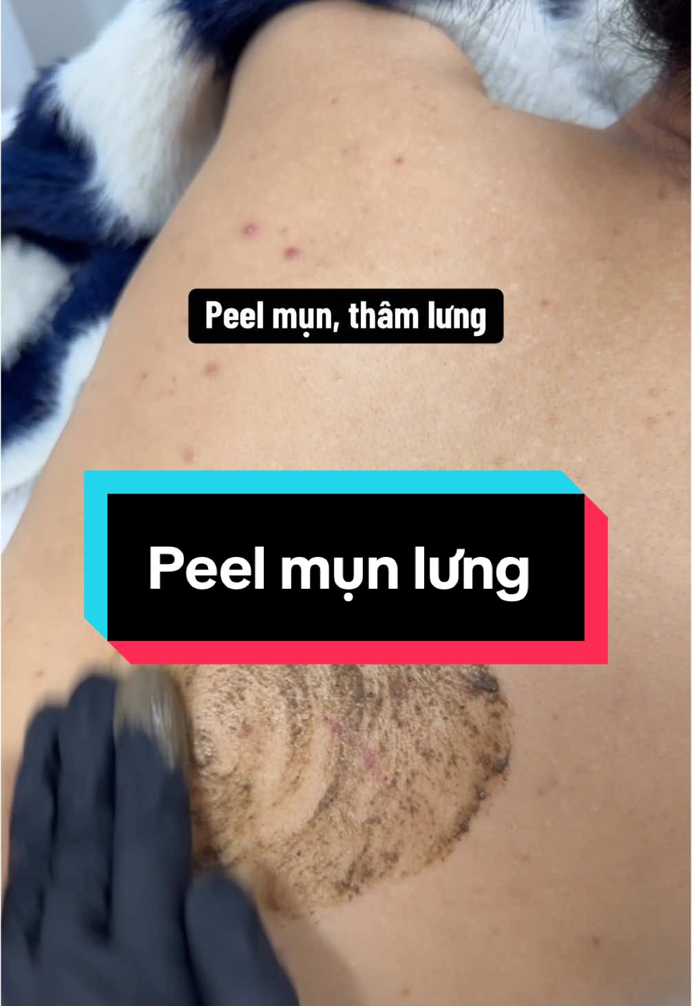 Peel mụn lưng giúp bạn tự tin vào hè#peellung #munlung #hanquoc한국 #xuhuongtiktok #xuhuong #hanquoc🇰🇷 #spataihanquoc #trimuntaihan #hmbeauty #chamsocdataihanquoc #dieutrimuntaihanquoc #dhshanquoc 