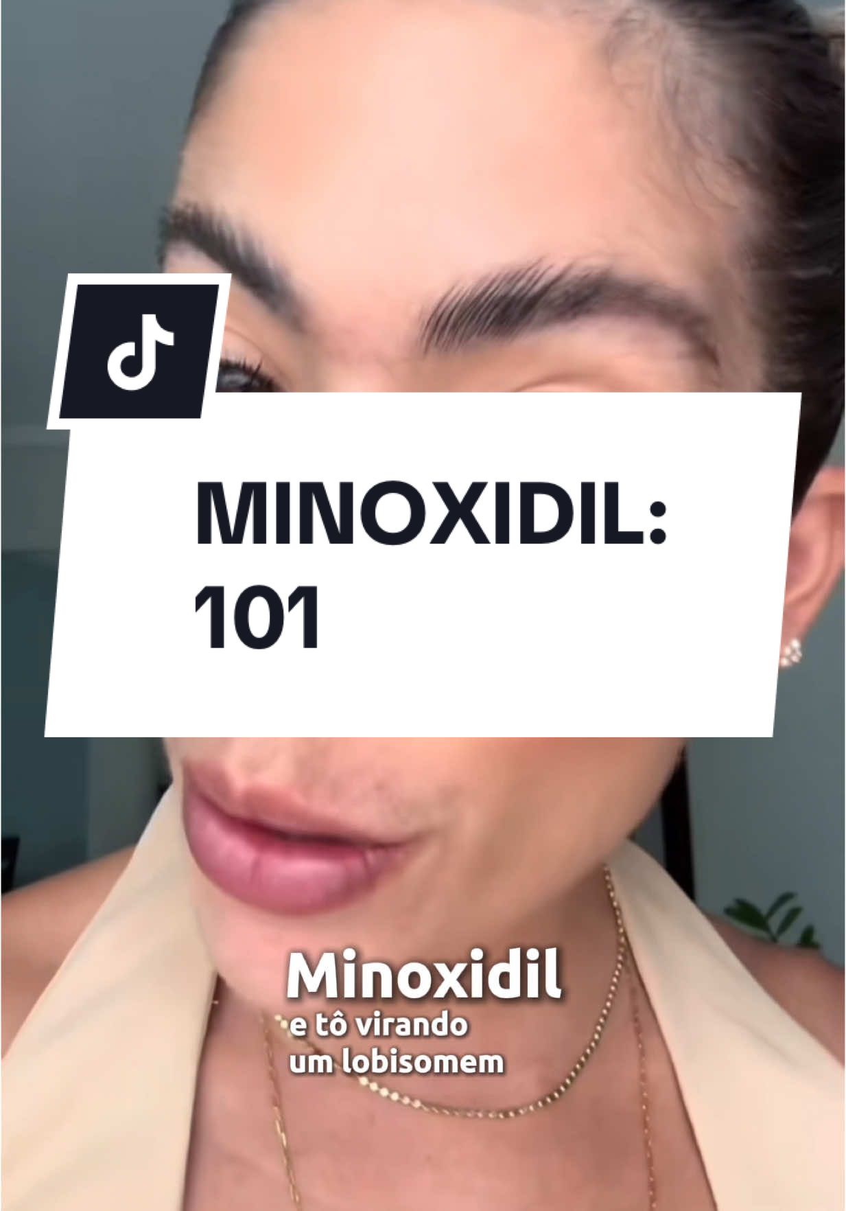 Tudo que você PRECISA saber antes de usar Minoxidil!  1️⃣ Shedding: A queda inicial pode assustar, mas é comum e temporária. 2️⃣ Cuidado com crianças e pets: O uso tópico de Minoxidil pode ser perigoso para eles! 3️⃣ Alergia ao propilenoglicol e álcool: Fique atento a coceira, vermelhidão ou descamação. 4️⃣ Paciência é essencial: Os resultados começam a aparecer após 6 meses de uso contínuo. 5️⃣ Queda após a suspensão: Em até 3 meses após parar o uso, os fios podem voltar a cair. ⚠️ Consulte sempre seu dermatologista para garantir segurança e eficácia no tratamento! #Minoxidil #CuidadosComOCabelo #Tricologista #Dermatologista