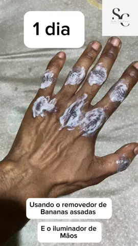 Como Remover manchas causadas por uso de cremes com alto índice de hidroquinona, e deixa bananas assadas nos dedos ? Use um removedor para clarear profundamente e um iluminador de mãos, tudo em uk unico kit ✔️ SYMBA COSMÉTICOS revela o teu brilho  939566300  #skincare 