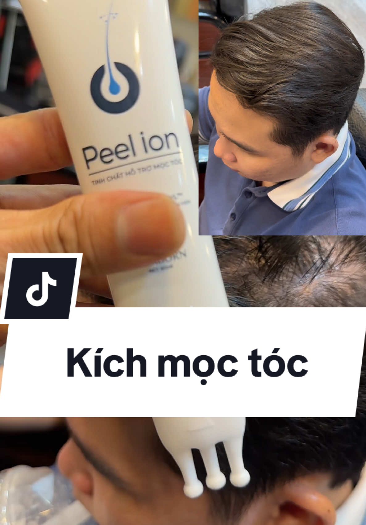 Kích mọc tóc hair born , giúp mọc móc , chống rụng tóc #rin97 #lanmoctoc #hairborn #kichmoctoc 