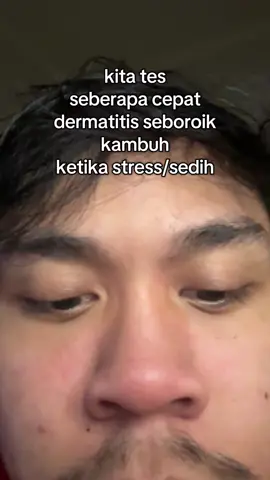 begitu guys sensitifnya 😭 🙏#dokter #dokterinternship #medstudent #dermatologist 