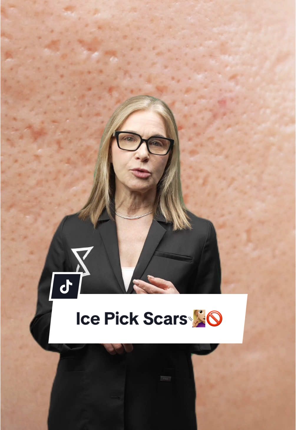 Ice pick scars? 🔍 Those tiny, deep marks from past breakouts can be stubborn, but not impossible to treat! 💡 TCA peels, microneedling, and retinoids can help smooth and rebuild skin over time. Patience is key—consistent care makes all the difference! ✨ #AcneScars #IcePickScars #ClearSkin #SkinHealing #TCApeel #Microneedling #Retinoids #SkinCareTips #AcneSolutions #GlowingSkin #ScarTreatment #BeautyRoutine