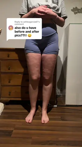 Replying to @ashleygarcia87 Sure:) me one day before lipo & 2 weeks after. #fyp #lipedema 