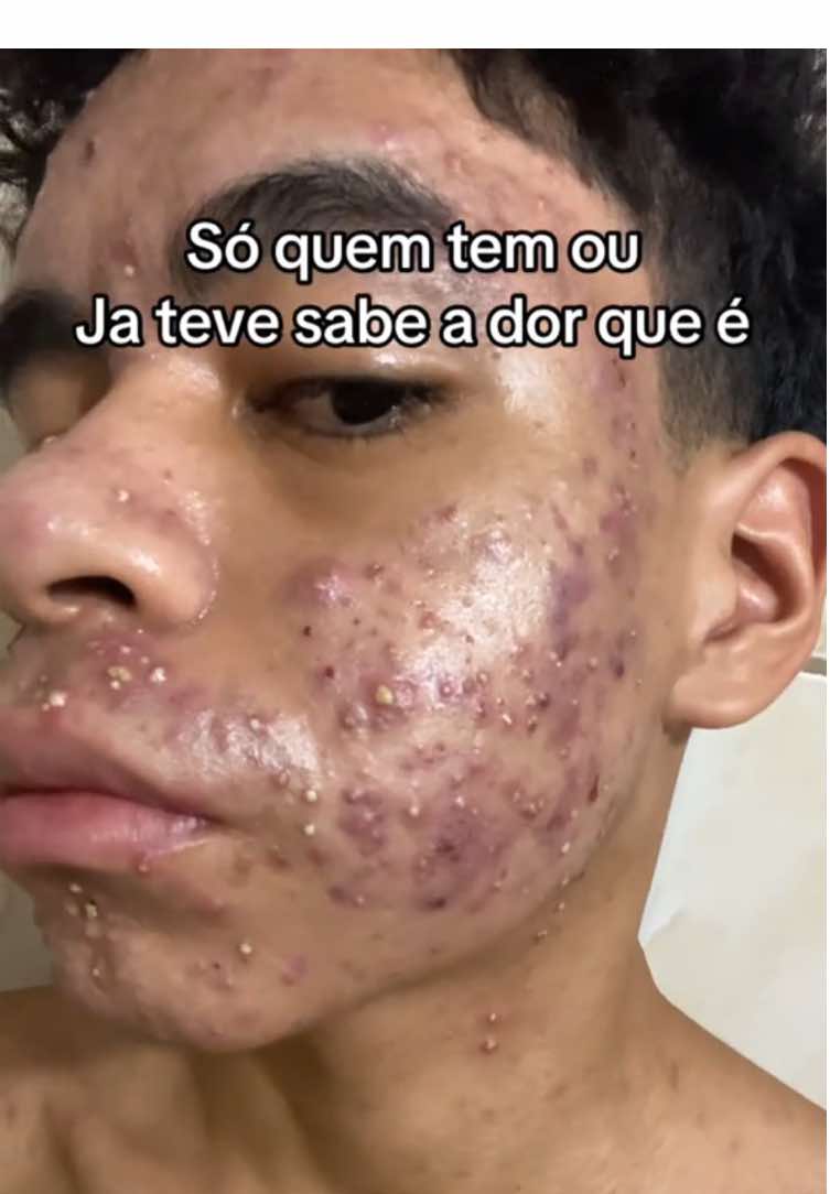 29 dias de tratamento e confiando no processo!🙏🙌🏼 #roacutan #isotretinoina #espinhas #acnes #autoestima #acnetratamento #skincare #fyp #foryou #cuidandodorosto #acnetreatment 