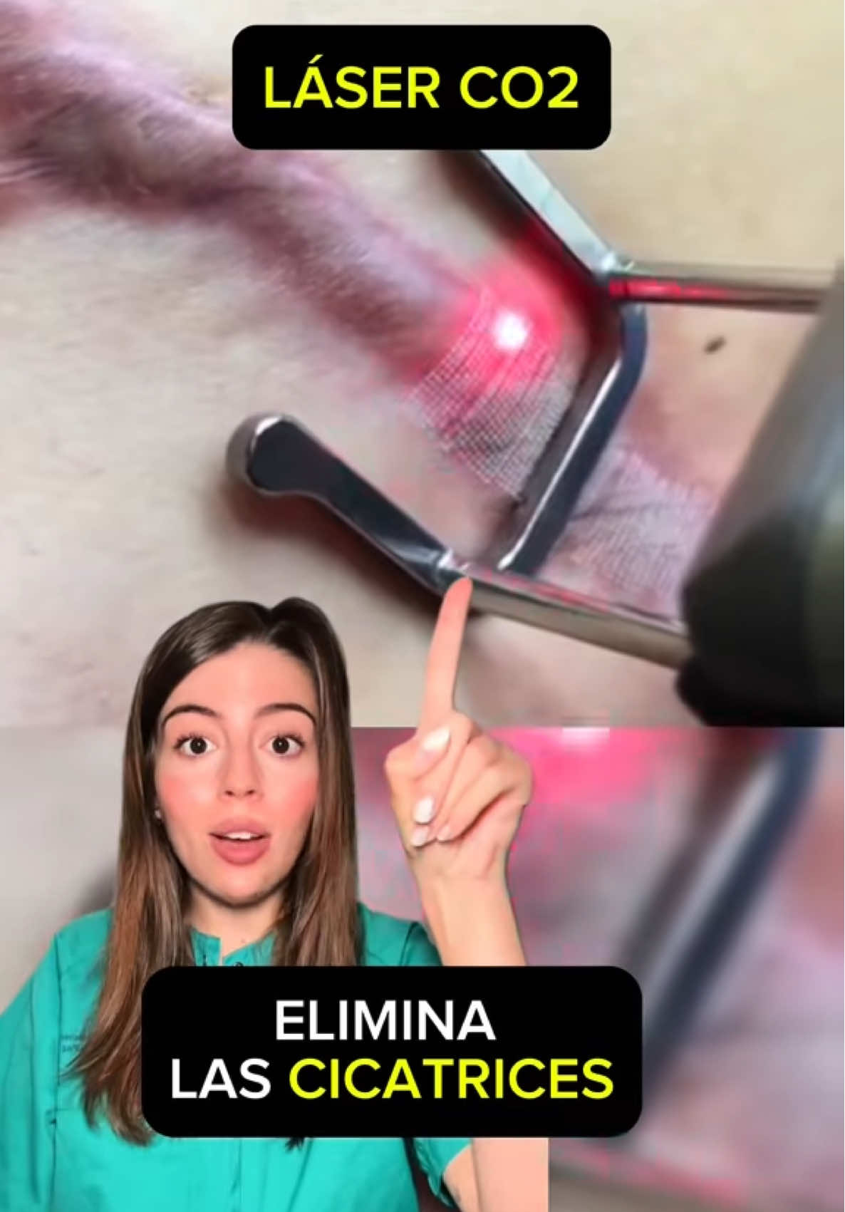 LÁSER CO2 PARA CICATRICES ➡️ #laser #laserco2 #cicatriz #queloide #cicatrizhipertrofica #herida #cuidadosdelaherida #pielsana #AprendeConTikTok #aprenderentiktok #enfermera #heridaquirurgica #cirugia 