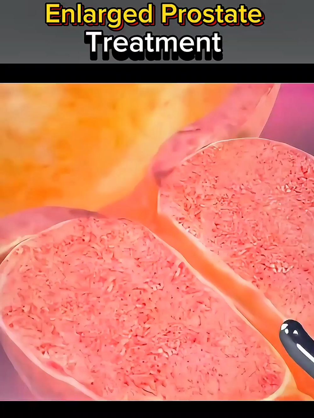 enlarged prostate treatment  #ProstateHealthMatters #KnowYourProstate #MensHealthAwareness #ProstateCare #HealthyProstateJourney #StopProstateProblems #ProstateEnlargementAwareness #TakeCareDownThere #MensWellnessTalk #ProstateWellness #fyp 