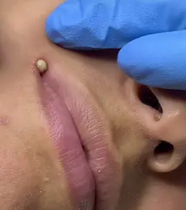 #cravoseespinhas #pimpletok #pimplepatch #satisfaction #satisfatório #pimplepop #squeezeyuk #cystpopping 