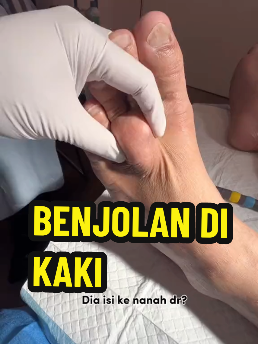 benjolan di kaki #benjolandikaki #benjolan #dryudieko #fyp 