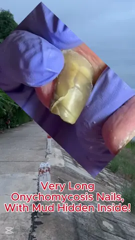 #toenails #ingrowntoenail #toenailremoval #onychomycosis #pedicure #cleaning #satisfyingvideo #usa🇺🇸 