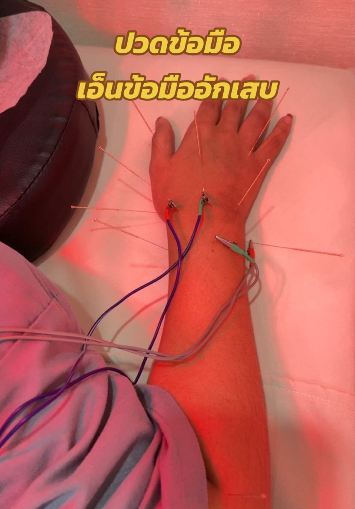 ปวดข้อมือ เอ็นข้อมืออักเสบ สามารถฝังเข็มรักษาได้ดีเลยนะคะ  #ปวดข้อมือ #เอ็นข้อมืออักเสบ #ฝังเข็ม #ฝังเข็มแก้ปวด #ออฟฟิศซินโดรม #มือชา #แพทย์แผนจีน #ฟาจินคลินิก 