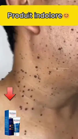 Éliminez toutes vos verrues et grains de beauté en quelques minutes seulement et retrouvez votre estime de soi
