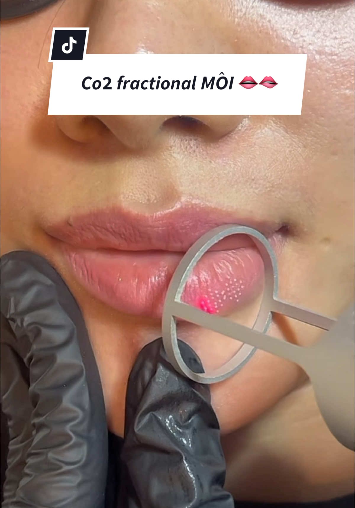 𝐂𝐨𝟐 𝐟𝐫𝐚𝐜𝐭𝐢𝐨𝐧𝐚𝐥 𝐌𝐎̂𝐈👄   nhận liên tục các ca môi bết,xỉn cũ ,nhăn nheo mỗi ngày#spaceleryquan12 #xoaxamantoan #xoaxamlaserpico #xoaxammoimaytattoomini #xoaxammoi #xoaxamkhongseo #xoámí #xoámimat #xoáchanmaytroxanh_trodo #xoachanmaysieusach #co2laser #trehoa #môi #hạtfordyce #co2fractionallasertreatment #co2 #xoá_xăm #hạmay #xoachanmay 