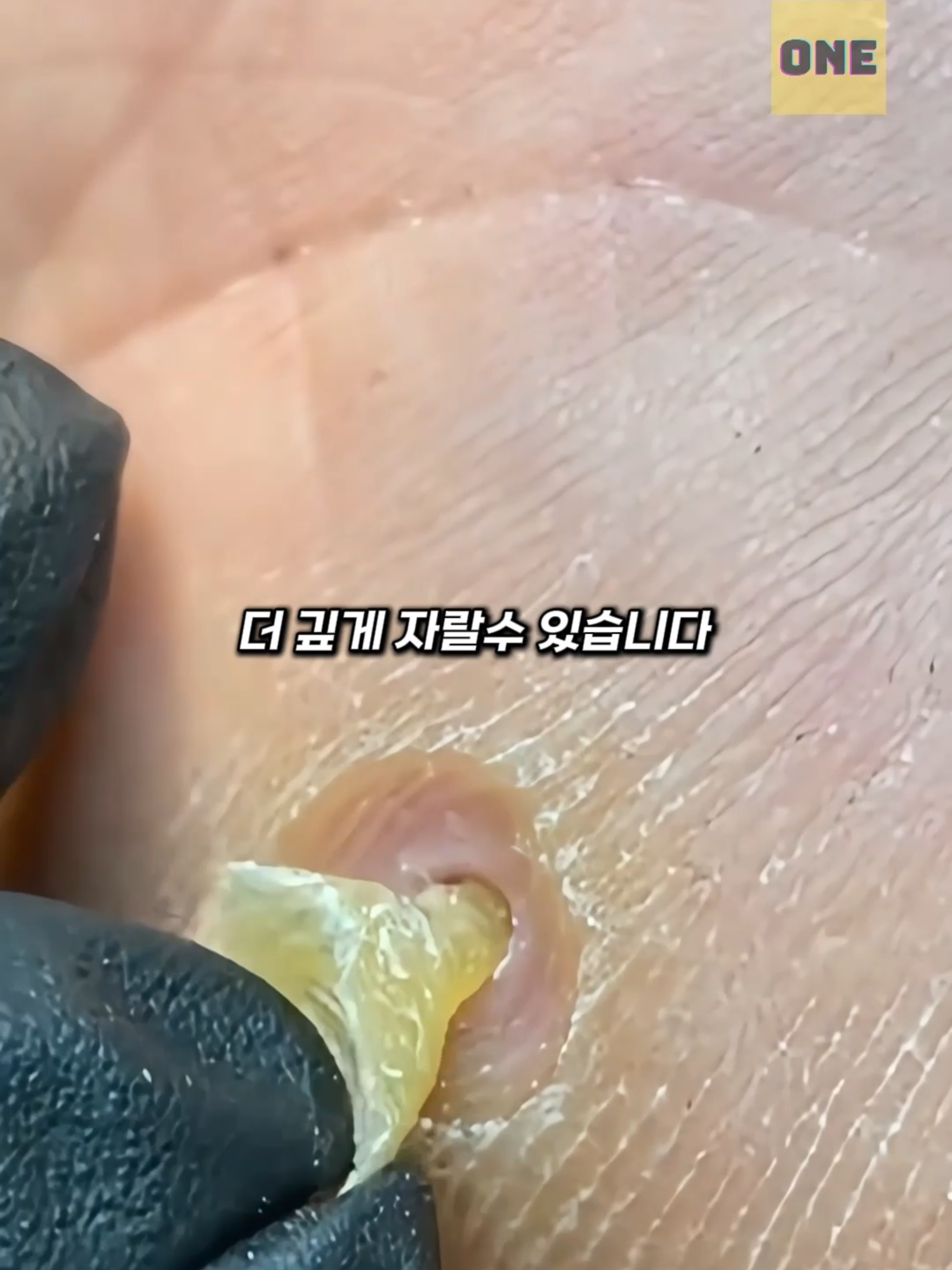 티눈을 무조건 제거하면 안 되는 이유 #티눈제거 #발관리 #피부건강 #cornremoval #footpain