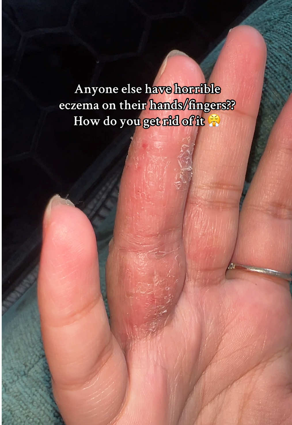 I hate it so much 😭😭 #eczema #eczematok #eczemaawareness #eczemaonhands #eczemaflareup #dryhands #skinpeeling #hateit #eczematiktok 