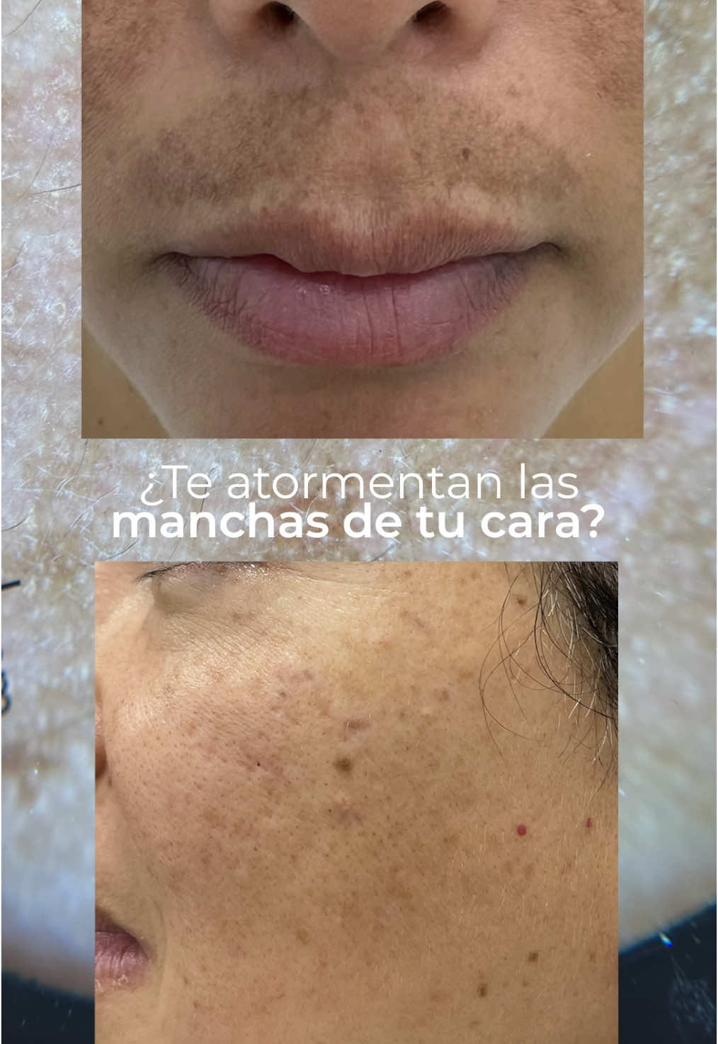 El melasma no desaparece solo pero sí tiene solución.  ¡Recupera tu confianza! 🧡💫 #manchas #hiperpigmentación #fyp #tratamientolaser #laserstarwalker #qaradermatologia