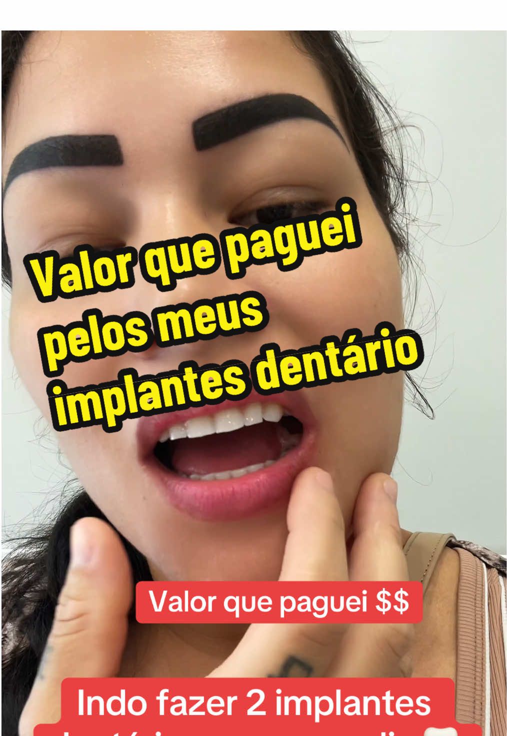 Vamos que paguei por 2 implantes dentário 🦷🦷 #implante #dente #dentista #esteticadental 