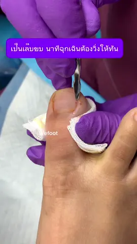นาทีนี้ต้องวิ่งให้เร็วเท่านั้น อย่าให้เล็บขบเป็นอุปสรรคนะคะ#ingrowntoenail #wefootตัดเล็บขบรักษาเล็บเชื้อรา #ตัดเล็บขบมียาชา #เล็บขบ #ตัดเล็บขบ #เล็บขบอักเสบ #เล็บขบหนักมาก 