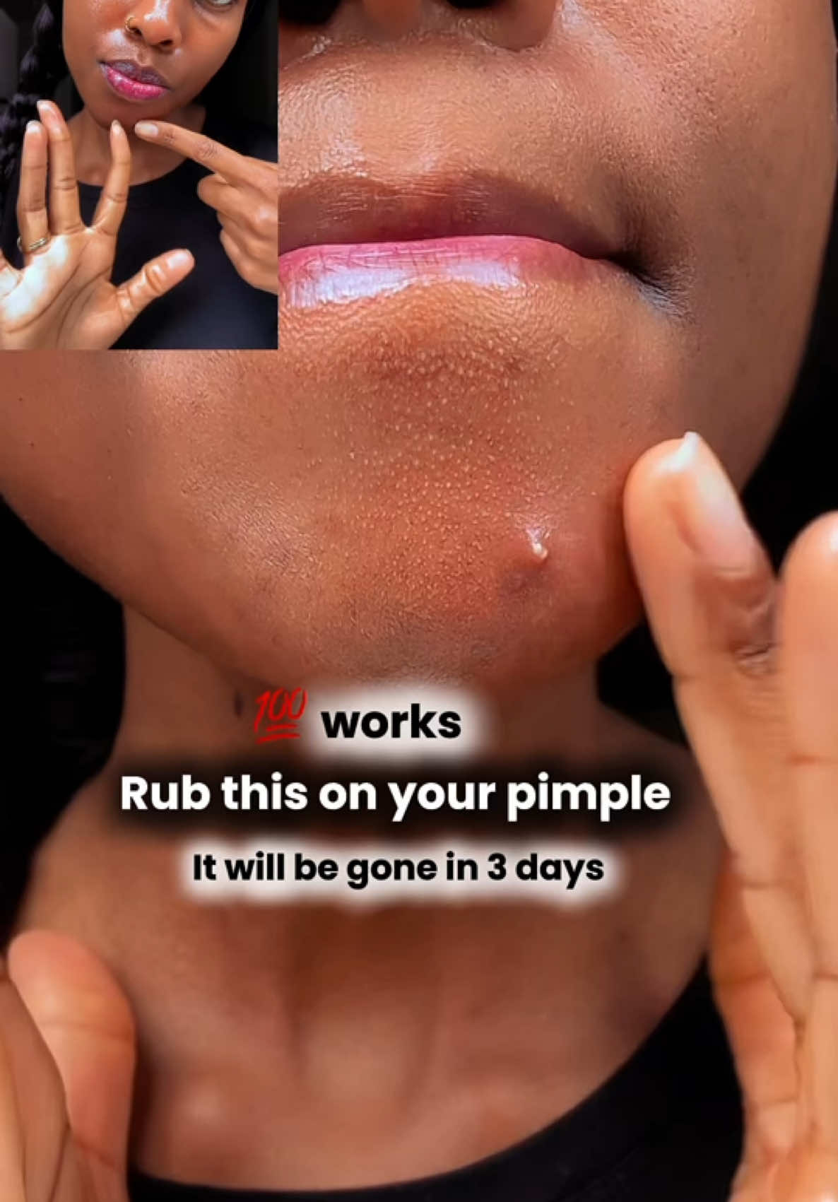 Rub this on your pimple. It will be gone in 3 days. This skincare hack works like magic💯 #reels #skincare #goviral #foryouu #howtotiktok #naturalbeauty #homeremedies #DIY #pimples 
