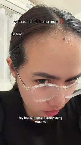 Mataas na hairline no more after 2 months using of these  @Hosoku  products. Trust the process #hosokuminoxidil #hosokuhairjourney #hosokuminoxidilhairgrower #hosokuminoxidil15percent #hosokushampoohairgrower #hosokudermaroller 