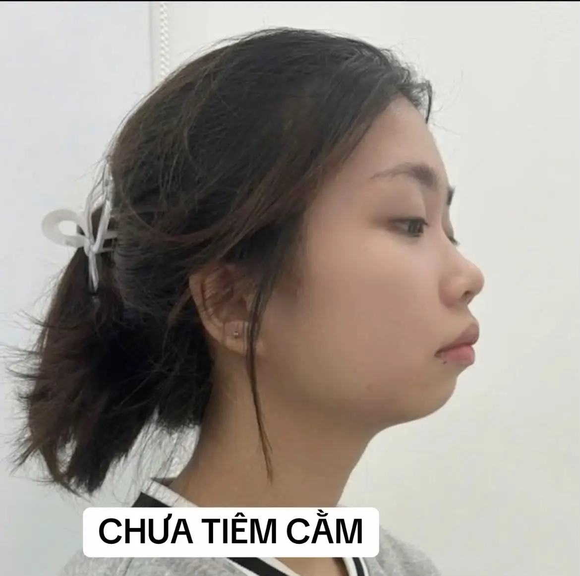 Sự khác biệt giữa chưa có cằm và có cằm sẽ như thế nào???? #tiemcam #xuhuong #khanhlybeauty 