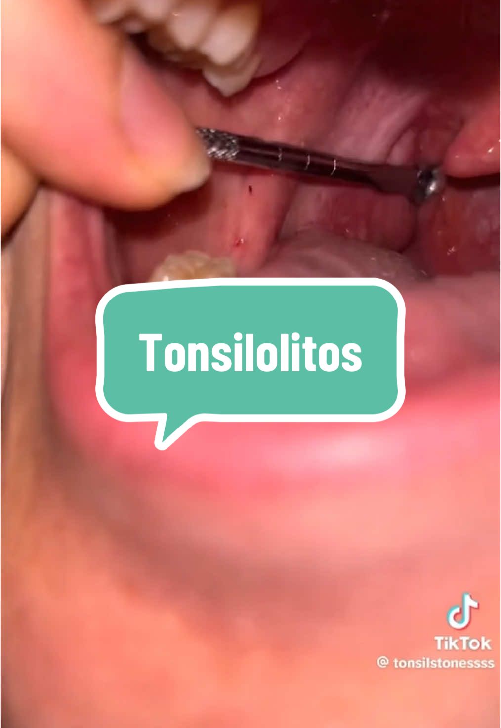 ¿Alguna vez escuchaste hablar de los tonsilolitos? #AprendeConTikTok #dentistatiktoker #askontiktok #LearnOnTikTok #tonsilolitos 