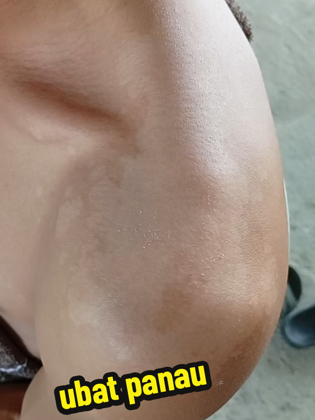 tolong eh beli spray ni kalau korang ada panau...