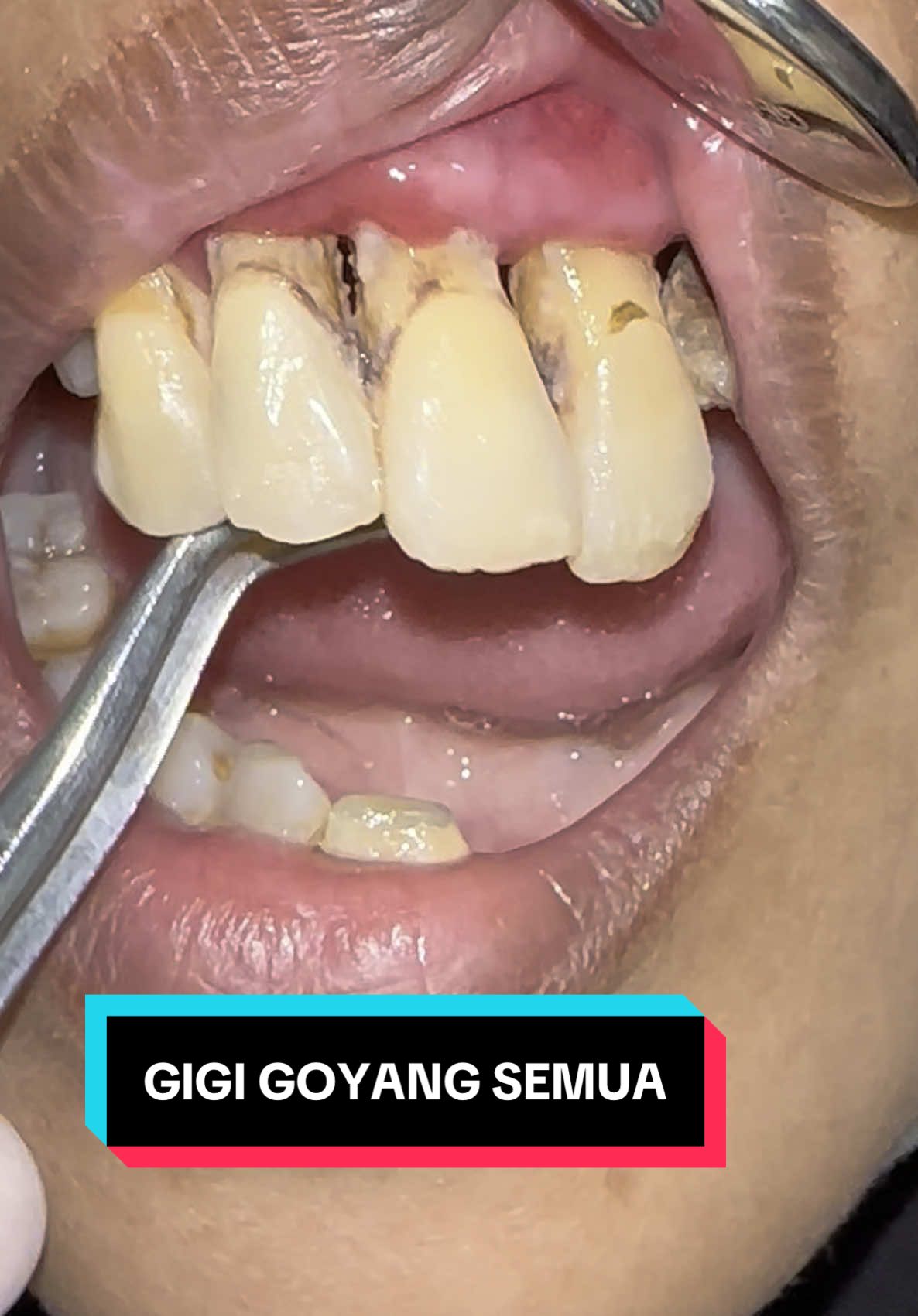 gigi goyang semua berujung tidak bisa mengunyah karena sakit. gigi yoyang seperti ini sudah sering banget terjadi pada pasien karena abai dan acuh terhadap kesehatan giginya . #fyp #fypdongggggggg #fypシ゚viral #foryoupage #fypシ #foryou 