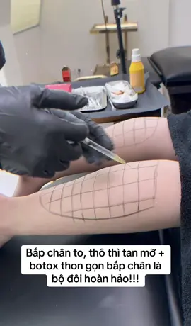 Bạn mê chân váy, quần đùi nhưng… bắp chân to, thô, cứng khiến bạn tự ti, che giấu suốt mùa hè? Tập hoài không nhỏ, mỡ không tan, cơ lại cuồn cuộn? Giải pháp đây: Tiêm Botox thư giãn cơ + Tan mỡ – bộ đôi hoàn hảo giúp bắp chân thon gọn, nuột nà mà không cần tập luyện cực khổ. Đừng để bắp chân làm bạn bỏ lỡ mùa hè! Thon nhanh – Đẹp tự nhiên chỉ với một liệu trình! #botox #filler #fullface #fyp #xuhuong #viral 