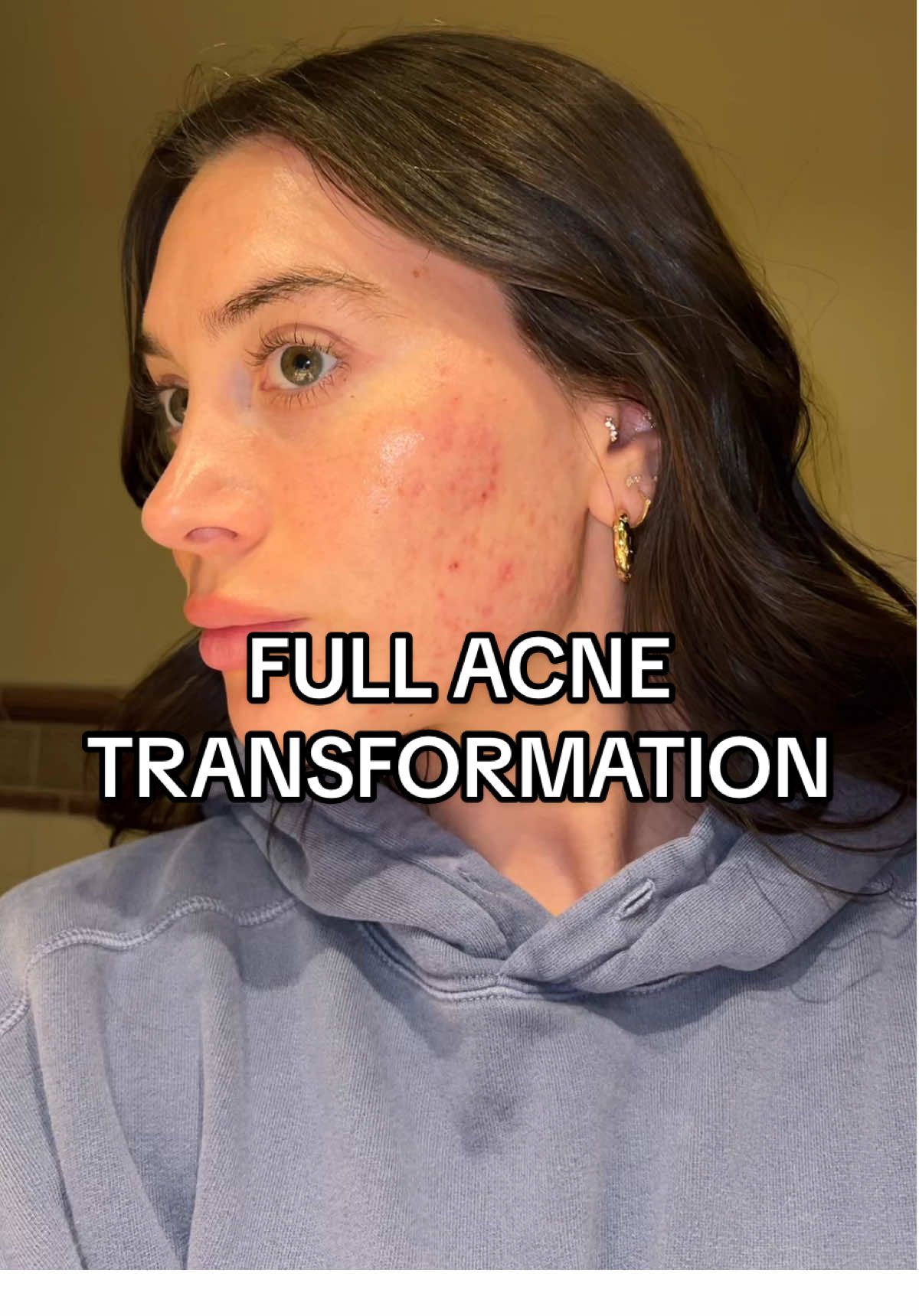 I couldn’t be happier to finally have clear skin😭🥹 if you know me you know how hard this journey was for me… I thought I’d never get here🙏🏼 #thankful #skin #journey #grateful #clearskin #acnefree #smooth #scars 