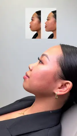 The power of chin filler.  #HouseOfBratz #chinfiller #filler #facial #beauty #fillers 