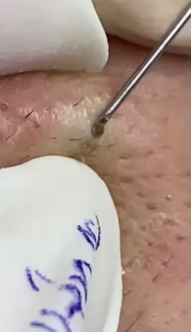 Bom diaaa!💗✨ #acneskin #viral_video #blackhead #removal #foryoupage #CleanTok #satisfaction 